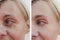 Woman wrinkles on face concept before and after patient injection anti-aging procedures