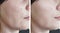 Woman wrinkles face before and after cosmetology cosmetology procedures