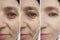 Woman wrinkles face before  after cosmetology effect plastic therapy procedure treatment arrow thread lifting,