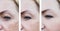Woman wrinkles on face, pigmentation removal dermatology before and after procedures