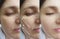 Woman wrinkles face before after rejuvenation correction effect plastic therapy procedure treatment arrow thread lifting,
