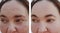 Woman wrinkles face before and after rejuvenation correction procedures dermatology