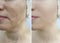 Woman wrinkles face results correction contour tension before and after contrast treatment