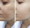 Woman wrinkles face results correction lifting  contour tension  before and after contrast treatment