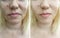 Woman wrinkles face results correction tension  before and after contrast treatment