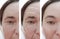 Woman wrinkles face rosacea before and after difference cosmetology therapy correction, arrow