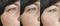 Woman wrinkles face swollen removal blepharoplasty therapy contrast before treatment difference sagging correction