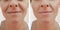 Woman wrinkles face before and after treatment cosmetic procedures