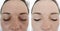 Woman wrinkles face before and after treatment  cosmetology treatments