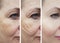 Woman wrinkles before and after lifting collage mature treatment procedures lift cosmetology effect treatments