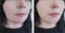 Woman wrinkles before and after oval cosmetology difference lift antiaging procedures