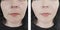 Woman wrinkles before and after oval  difference lift antiaging procedures