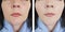 Woman wrinkles before and after oval effect  cosmetology difference lift antiaging procedures