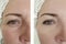 Woman wrinkles before after oval effect mature  cosmetology difference lift antiaging procedures