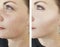 Woman wrinkles before after oval effect mature   removal cosmetology difference lift antiaging procedures