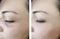 Woman wrinkles before after oval effect removal cosmetology difference lift antiaging procedures