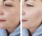 Woman wrinkles  removal before and after correction procedures