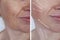 Woman wrinkles skin difference antiaging collagen before and after regeneration