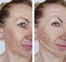 Woman wrinkles skin difference antiaging contours before and after regeneration