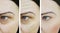 Woman wrinkles skin face lift removal rejuvenation therapy difference cosmetology before and after treatments