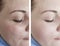 Woman wrinkles skin  before and after results regeneration mature treatment cosmetology treatments