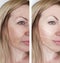 Woman wrinkles skin treatment before and after correction dermatology procedures regeneration