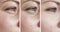 Woman wrinkles  swollen removal  lifting  blepharoplasty   therapy contrast before treatment difference sagging correction