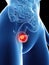 A womans bladder cancer