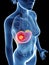 a womans liver cancer