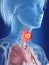 A womans thyroid gland cancer