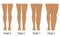 Women`s legs in different stages of Lymphedema