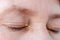 Womens eyelids with small growths due to disorders of lipid metabolism. Medical and cosmetology problem