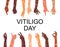 World vitiligo day poster.Hands different ethnicities in various gestures with skin disease.