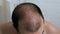 Worrying about hair loss.Slow motion a balding man in front of a mirror takes care of his hair, uses a means for hair