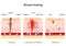 Wound healing. Stages of the post-trauma repairing process