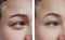 Wrinkle girl before and after procedures difference, correction