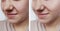 Wrinkle girl before and after removal procedures difference, correction