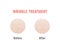 Wrinkle treatment comparison illustration vector on white background. Skin concept.