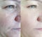 Wrinkle woman face before after lifting difference treatment removal of rosacea