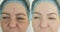 Wrinkle woman face before  after treatment  removal  of rosacea