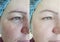 Wrinkle woman face before  after treatment of rosacea