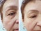 Wrinkles elderly woman face concept before and after cosmetic procedures, therapy, anti-aging