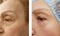 Wrinkles elderly woman face before and after cosmetic procedures, therapy, anti-aging