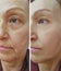 Wrinkles elderly woman face hydrating correction before and after cosmetic procedures, therapy, anti-aging