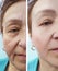 Wrinkles elderly woman face hydrating before and after cosmetic procedures, therapy, anti-aging