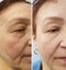 Wrinkles elderly woman face hydrating health correction before and after cosmetic procedures, therapy, anti-aging