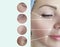 Wrinkles before after skin aging collage procedure lifting correction results