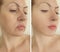 Wrinkles woman sagging face before and after lifting treatment