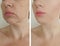 Wrinkles woman  sagging face before and after treatment