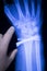 Wrist injury metal implant xray scan